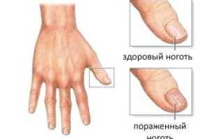 Обзор лекарств от грибка ногтей на ногах — список самых эффективных препаратов