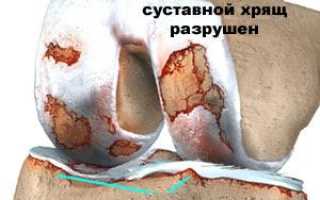 Что такое гонартроз коленного сустава и как его лечить правильно