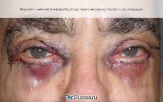 Советы по реабилитации после блефаропластики верхних и нижних век. Препараты и процедуры для заживления