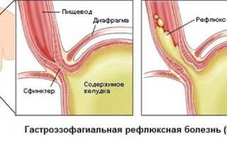 Из-за чего у детей развивается гастроэзофагеальный рефлюкс и как его лечить?