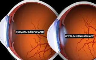 Какой хрусталик лучше при катаракте: как правильно выбрать ИОЛ