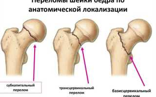 Как лечить перелом шейки бедра правильно и эффективно