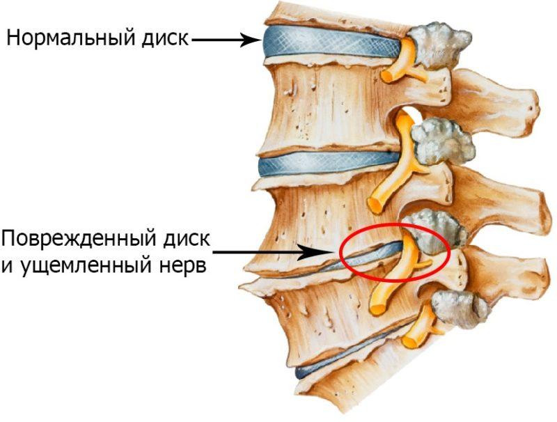 Как лечить экстрасистолию при остеохондрозе