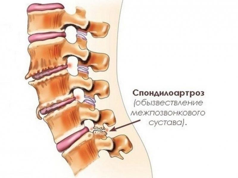 Что такое спондилоартроз поясничного отдела позвоночника и как его лечат