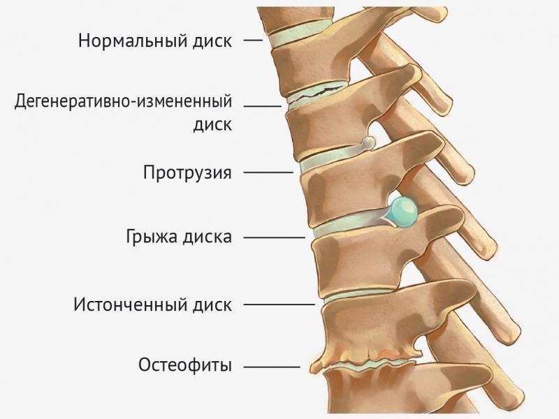 Что такое дорсопатия позвоночника