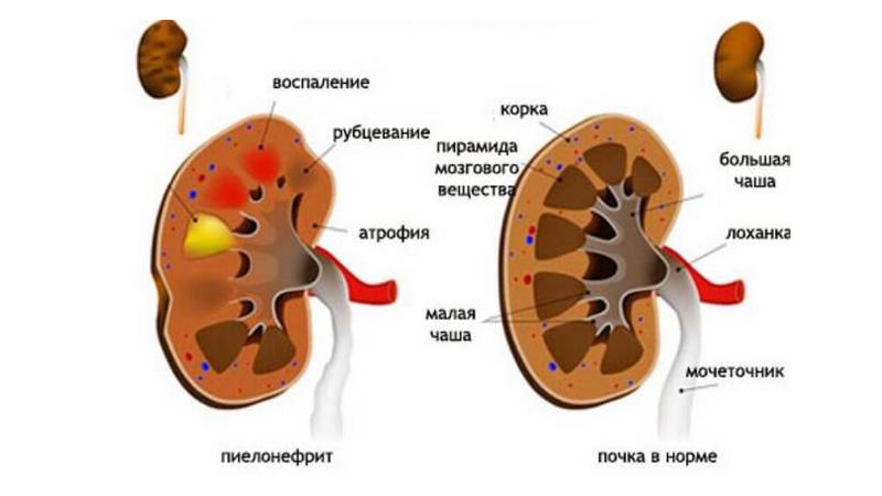 Как лечить тянущие боли в пояснице
