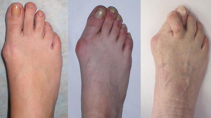 Как лечить артроз стопы