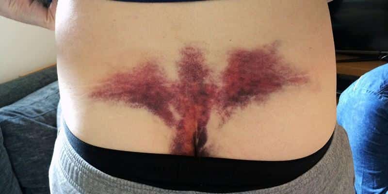 Что делать при ушибе копчика