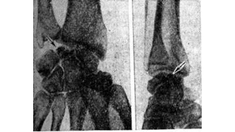 Как лечить болезнь Кинбека