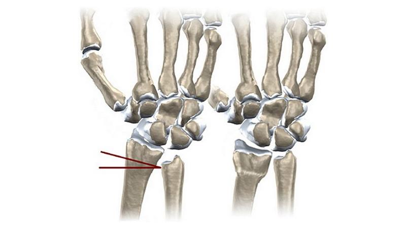 Как лечить болезнь Кинбека
