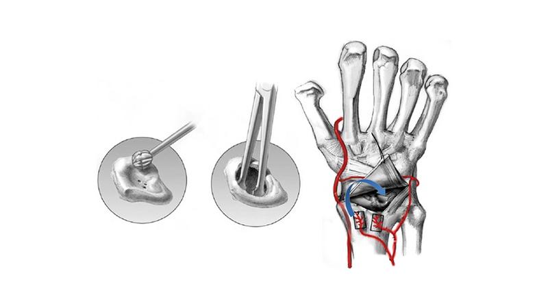 Как лечить болезнь Кинбека