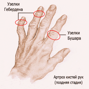Как лечить узелки Гебердена и Бушара
