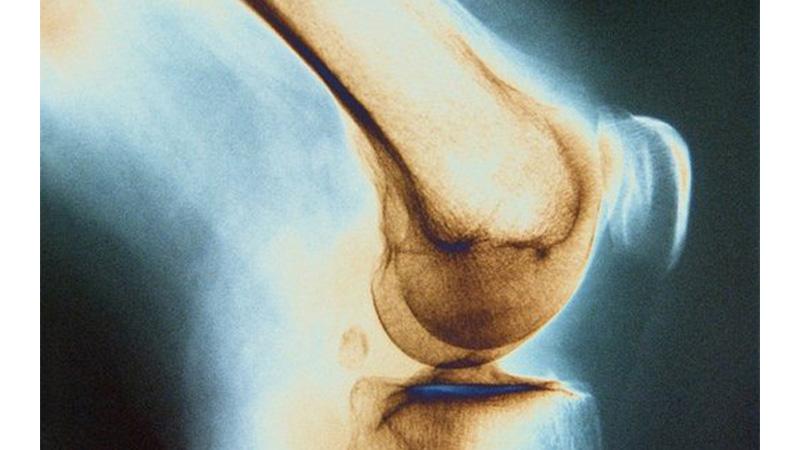 Туберкулез костей