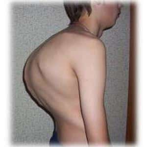 Туберкулез костей