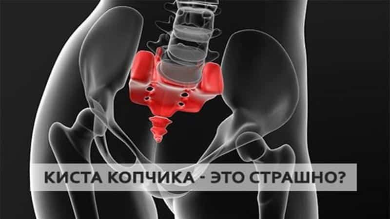 Как лечить воспаление копчикового хода
