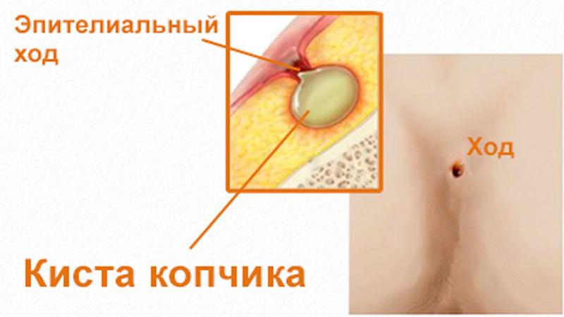 Как лечить воспаление копчикового хода