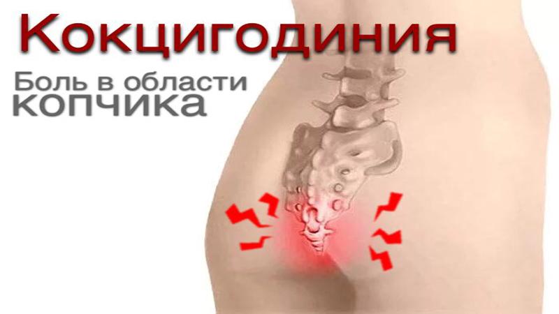 Как лечить воспаление копчикового хода