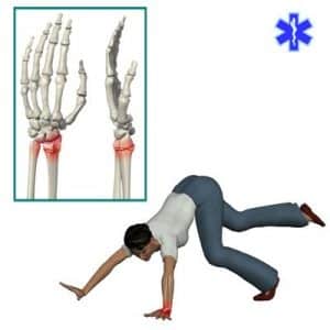 Что делать при вывихе кисти