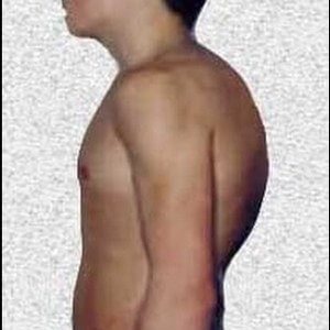 Как убрать горб на спине