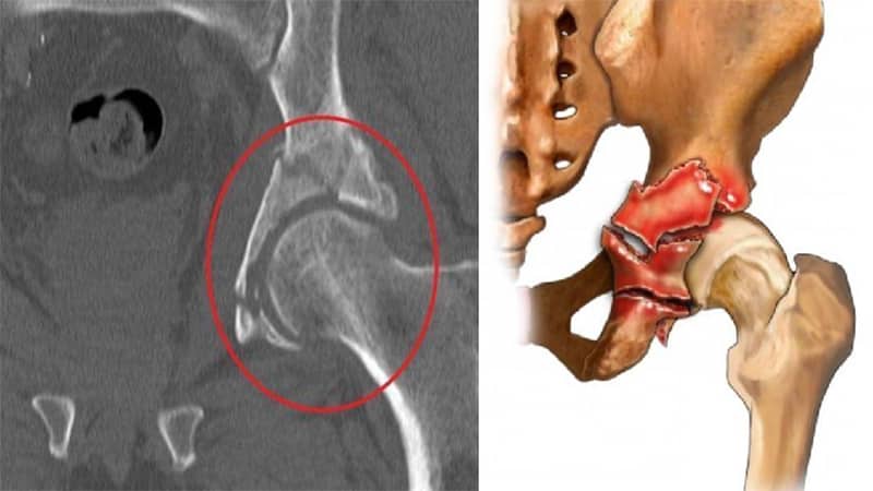 Как устроена вертлужная впадина тазовой кости и чем опасны её травмы