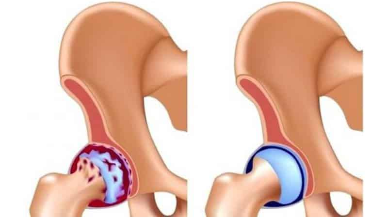 Как устроена вертлужная впадина тазовой кости и чем опасны её травмы