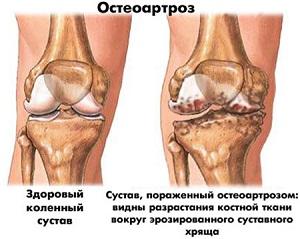 Как избавиться от хруста в коленях