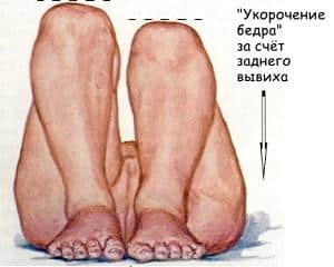 Как вправить тазобедренный сустав