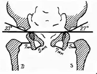 Что такое ацетабулярные углы