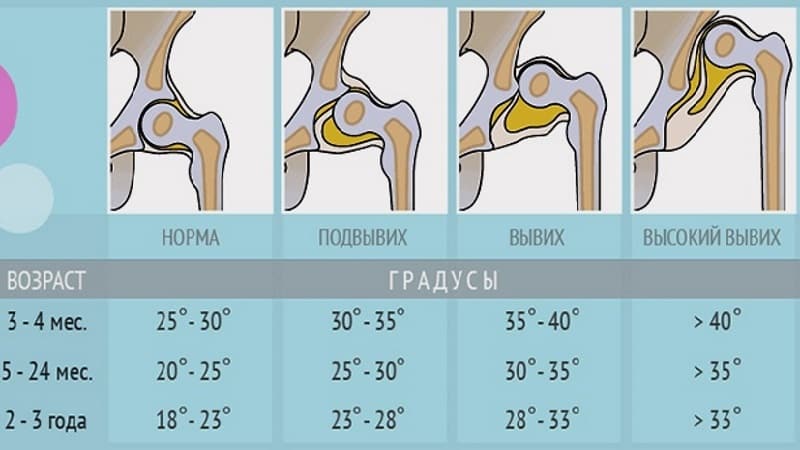 Что такое ацетабулярные углы