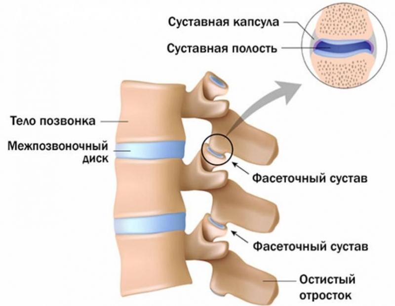 Как лечить спондилоартроз грудного отдела позвоночника