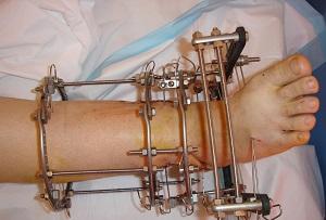 Как делают артродез голеностопного сустава