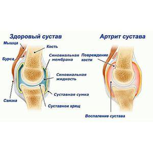 Как применять Коллаген Ультра для суставов