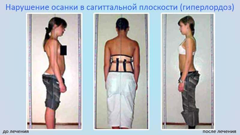 Как лечить лордоз поясничного отдела