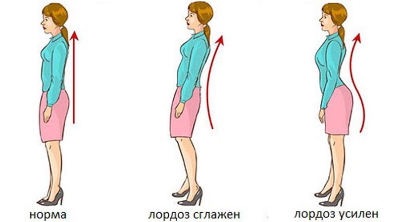 Как лечить лордоз поясничного отдела