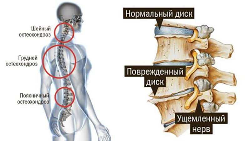 Как лечить боль в сердце при остеохондрозе