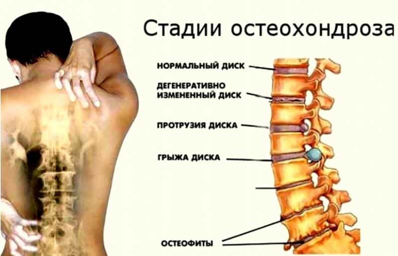 Как лечить грыжу грудного отдела позвоночника