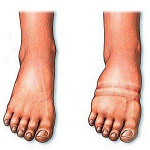 Что делать, если опухают ноги ниже колен