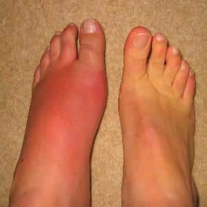 Что делать, если опухают ноги ниже колен