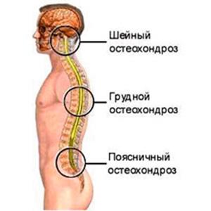 Какие таблетки принимают при остеохондрозе