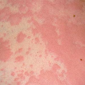 Как принимать мазь Преднизолон