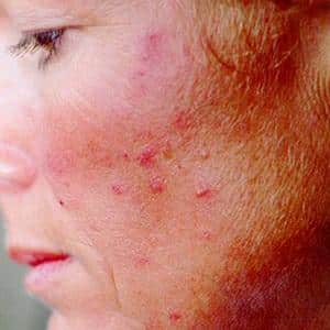 Как принимать мазь Преднизолон