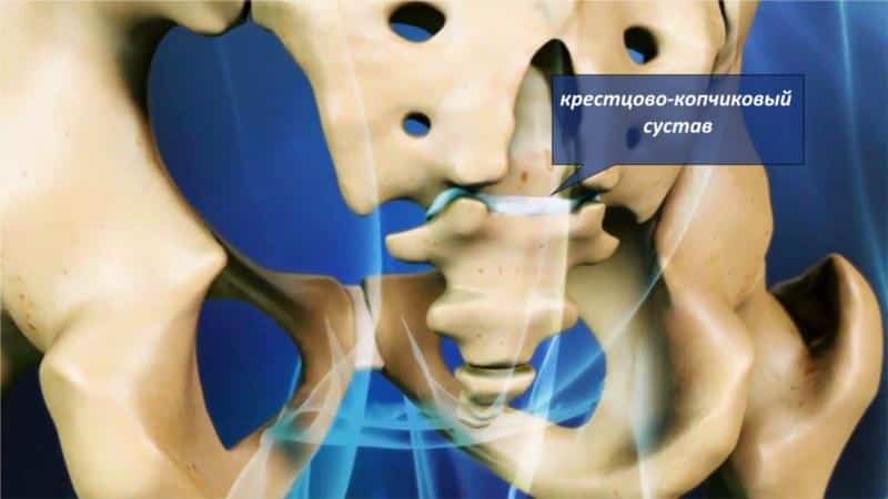 Как лечат перелом копчика