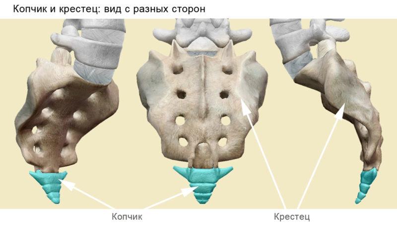 Как лечить перелом крестца