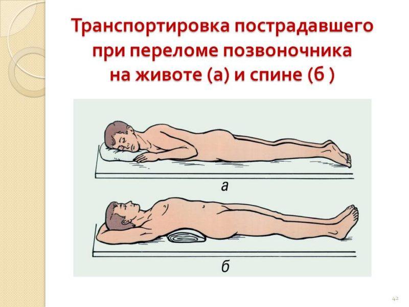 Как лечить перелом крестца