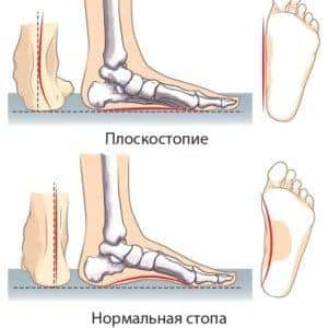 Как определить плоскостопие в домашних условиях