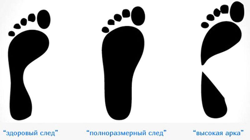 Как определить плоскостопие в домашних условиях
