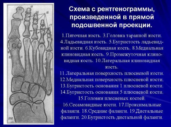 Как определить плоскостопие в домашних условиях