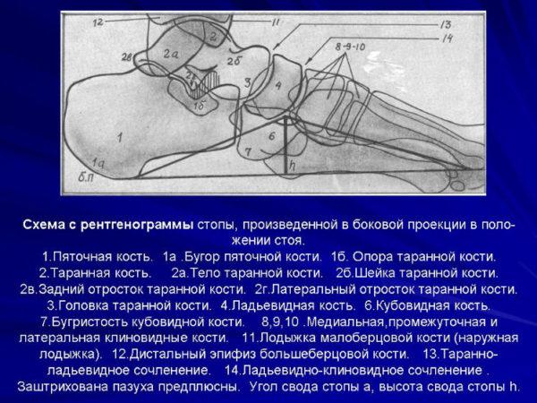 Как определить плоскостопие в домашних условиях