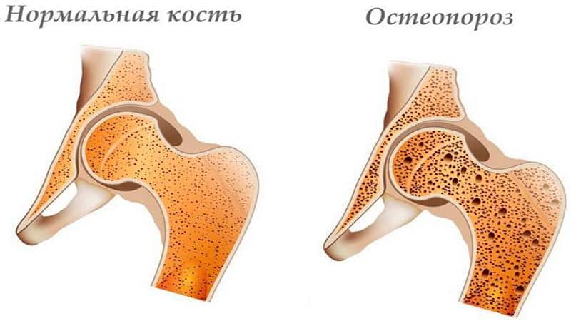 Как лечить остеопороз тазобедренного сустава