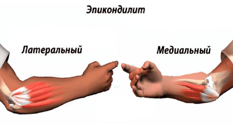 Как лечить растяжение связок локтевого сустава